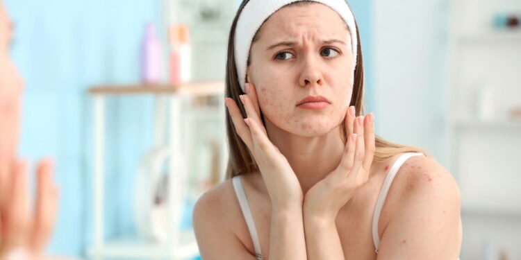 Esse erro comum está por trás da acne que aparece depois dos 30