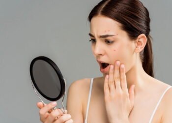 Esse erro comum está por trás da acne que aparece depois dos 30