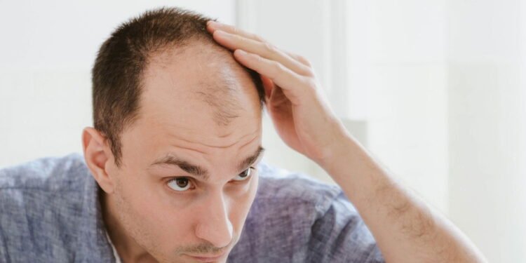 Consumir essa bebida aumenta 57% chance de calvície nos homens