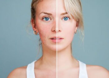 Tem pele oleosa? Esse guia pode te ajudar muito a resolver o seu problema!