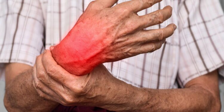 Sintomas que podem indicar artrite e precisam de atenção