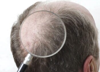 Gel de açúcar pode ajudar no tratamento contra calvície; confira!