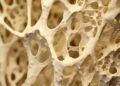 Como funciona a técnica inovadora que reverteria a progressão da osteoporose
