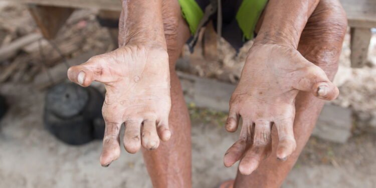 esse é o segredo médico mais promissor contra a hanseníase no Brasil - Créditos: depositphotos.com / frankviryapan.gmail.com