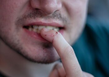 É verdade que roer unhas pode causar AVC?