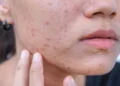 Virginia sofreu e você pode ser a próxima, médica desvenda a Acne da mulher Adulta!