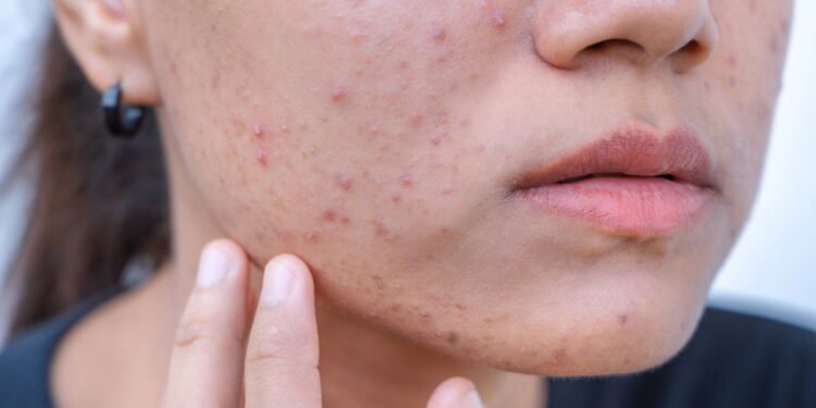 Acne em mulheres adultas: causas, tratamentos e prevenção - Créditos: depositphotos.com / maemodnit