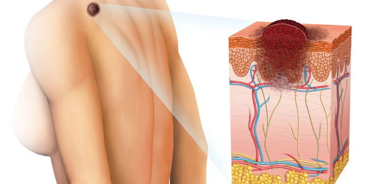 Melanoma: por que o risco varia entre homens e mulheres? - Créditos: depositphotos.com / Alexilus