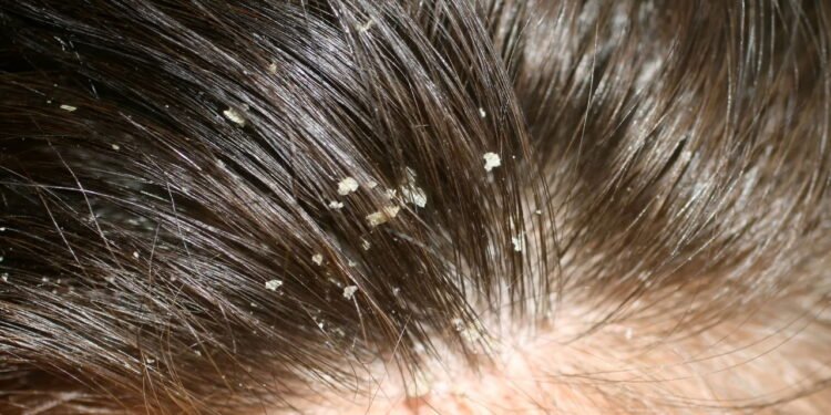 O cuidado mais ignorado que faz toda diferença contra caspa persistente