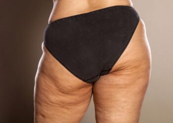 Como eliminar a celulite com atividade física de forma simples?