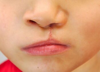 SUS agora oferece cirurgia gratuita para Lábio Leporino!