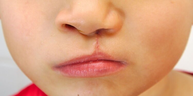 essa descoberta sobre lábio leporino pode emocionar o Brasil inteiro - Créditos: depositphotos.com / jorgecachoh