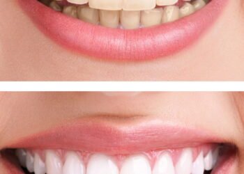 Sorriso amarelado? 7 vilões diários que estão manchando seus dentes!