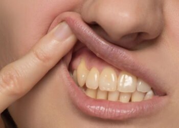 Sorriso amarelado? 7 vilões diários que estão manchando seus dentes!