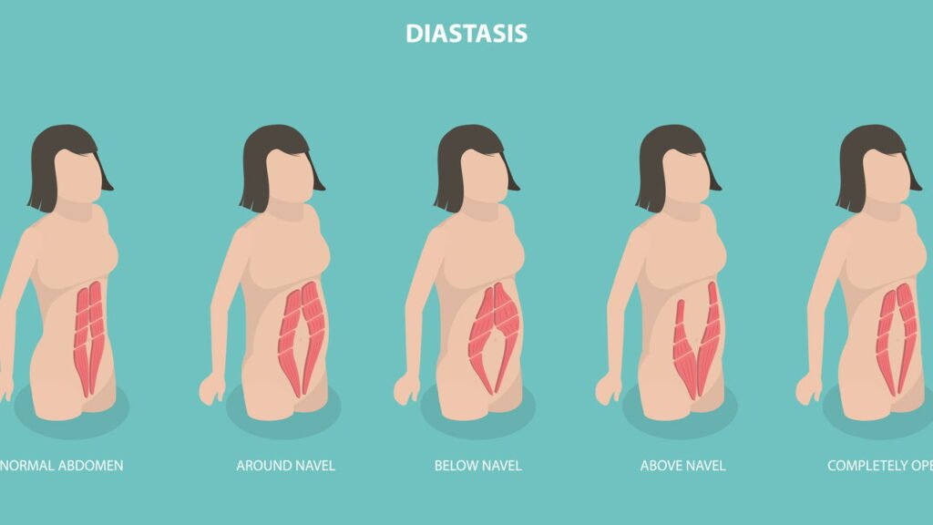 Mulheres podem realizar esses exercícios para ajudar na melhora da diástase abdominal