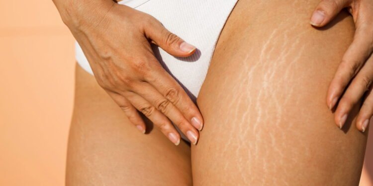 Novo tratamento para estrias chama atenção por resultados rápidos e técnicas inusitadas que transformam a aparência da pele. - Créditos: depositphotos.com / yan_c@bigmir.net