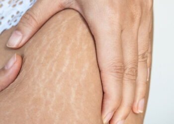 O tratamento mais eficaz contra Estrias finalmente revelado