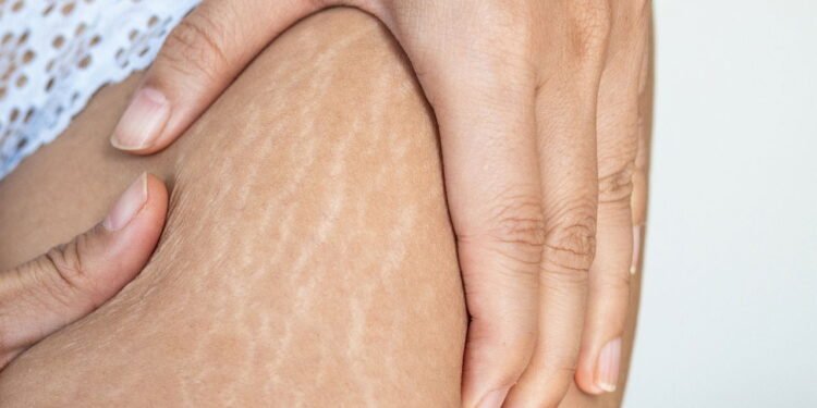 estrias  - Créditos: depositphotos.com / yan_c@bigmir.net