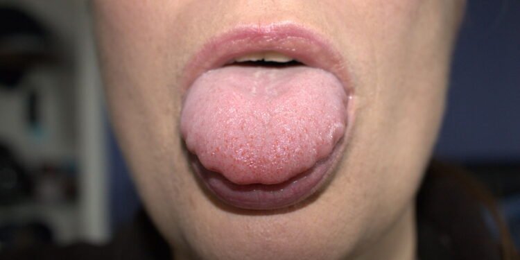 língua geográfica: quando se preocupar e como evitar o desconforto- Créditos: depositphotos.com / cheekylorns2