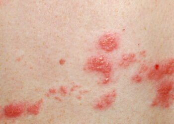 Sofre com Micose? Estes 7 remédios caseiros são incríveis!