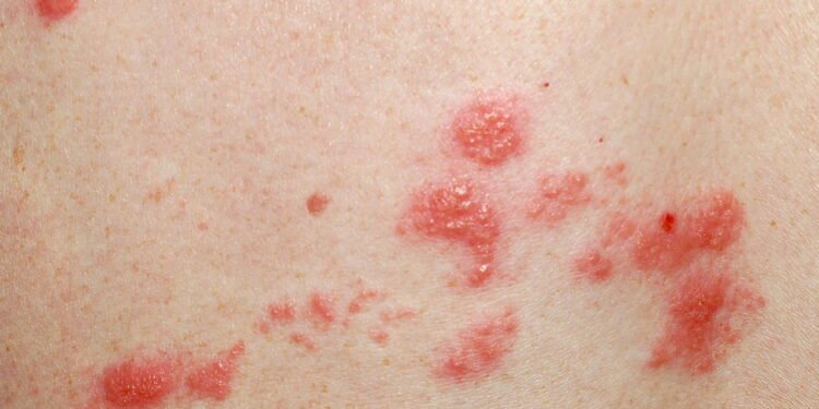 micose - Créditos: depositphotos.com / svanhorn