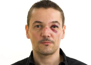 Nariz Torto incomoda? Veja o que pode causar e como corrigir