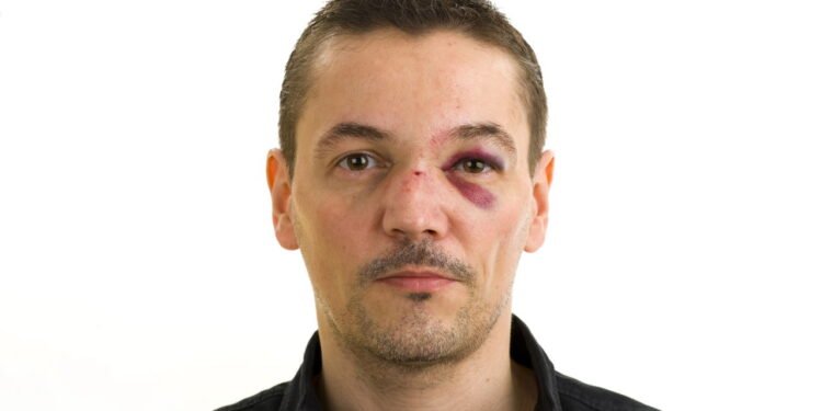 Nariz Torto: Causas, Sintomas e Tratamentos Que Você Precisa Conhecer - Créditos: depositphotos.com / macky_ch