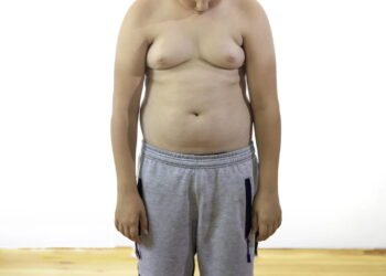 Obesidade precoce aumenta risco de morte em 84%