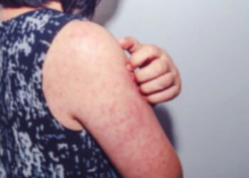 Doença erradicada volta com força e assusta o Brasil