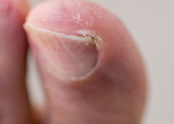 Como acabar com Unhas Encravadas sem sair de casa