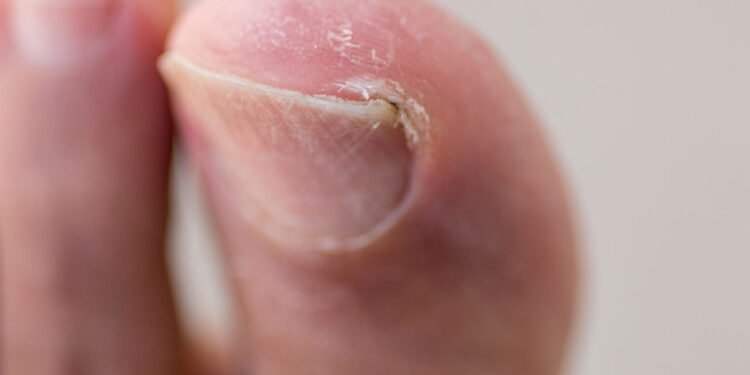 o que fazer quando a unha encrava? veja antes de cortar - Créditos: depositphotos.com / marcoscasiano