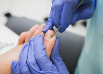 Como acabar com Unhas Encravadas sem sair de casa