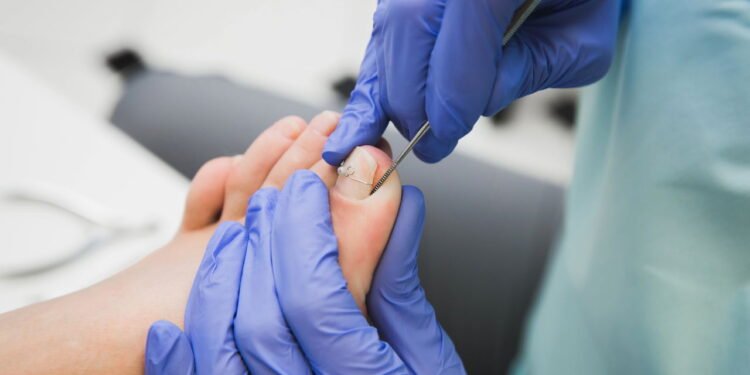 unha encravada? essa dica simples pode evitar cirurgia - Créditos: depositphotos.com / bondarech