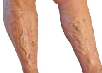 Estudo revela o impacto mais assustador das Varizes no cérebro