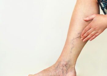 Estudo revela o impacto mais assustador das Varizes no cérebro