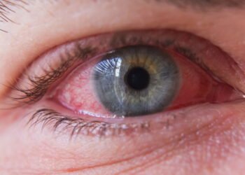 5 Remédios caseiros para Conjuntivite que realmente funcionam