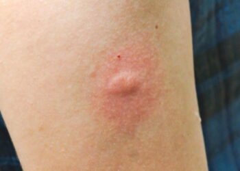 As 6 pomadas mais indicadas para tratar Picadas de Insetos