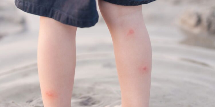 Picada de insetos- Créditos: depositphotos.com / zoeytoja