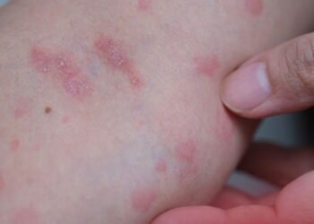 Chega de coçar! Descoberta reduz drasticamente a coceira da pele