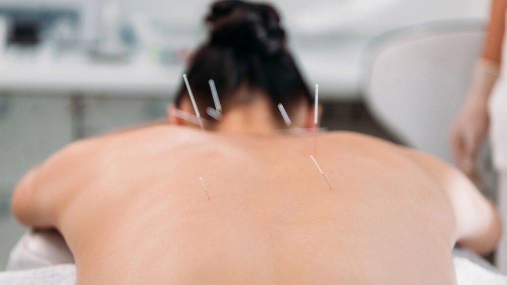 Acupuntura - Créditos: depositphotos.com / puhimec