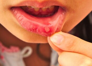 Como curar Aftas com remédios caseiros eficazes