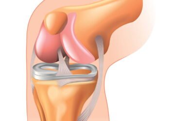 5 sinais de que os estalos nos joelhos não são tão inofensivos assim