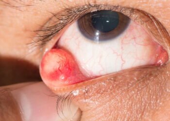 Tem um caroço no olho? Veja o que pode ser e como agir