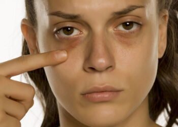 4 Remédios caseiros eficazes contra Olheiras