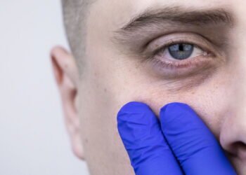 4 Remédios caseiros eficazes contra Olheiras