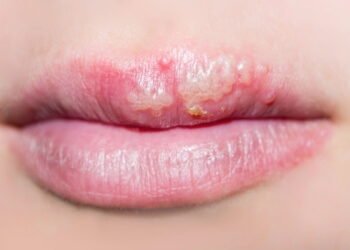 Entenda a Herpes e aprenda a controlar os surtos rapidamente