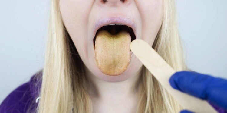 Lingua amarela -Créditos: depositphotos.com / Alena1919