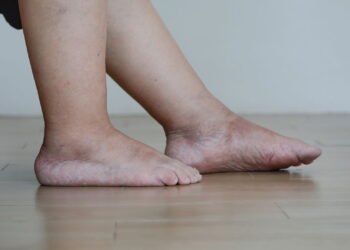 5 hábitos que reduzem o inchaço nas pernas no verão