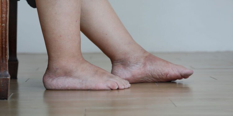 5 hábitos que reduzem o inchaço nas pernas no verão