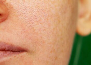 5 dicas eficazes para amenizar os Poros abertos